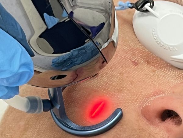 Rejuvenecimiento facial Láser CO2 fraccionado