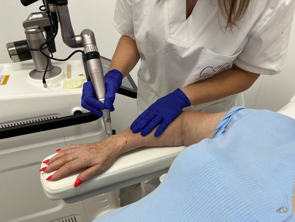 Tratamiento de eliminación de manchas con láser picosegundo en Castelldefels