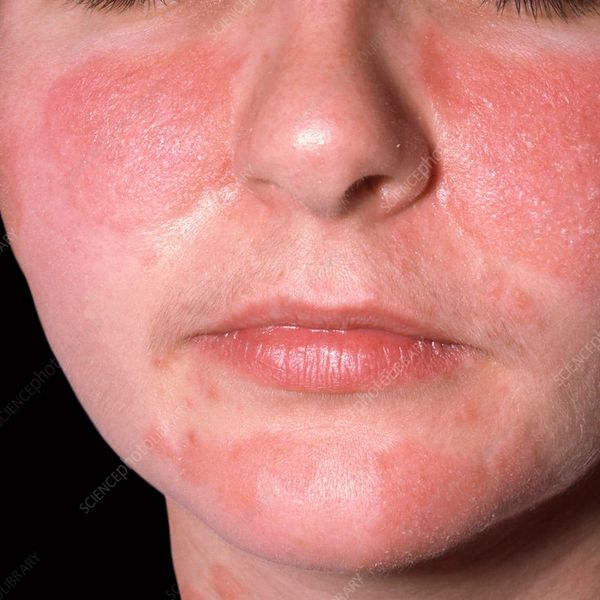 Alivia dermatitis seborreica con tratamiento calmante y regulador.