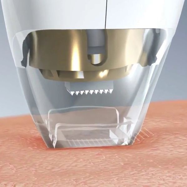 Close-up of a microneedling device penetrating the skin.