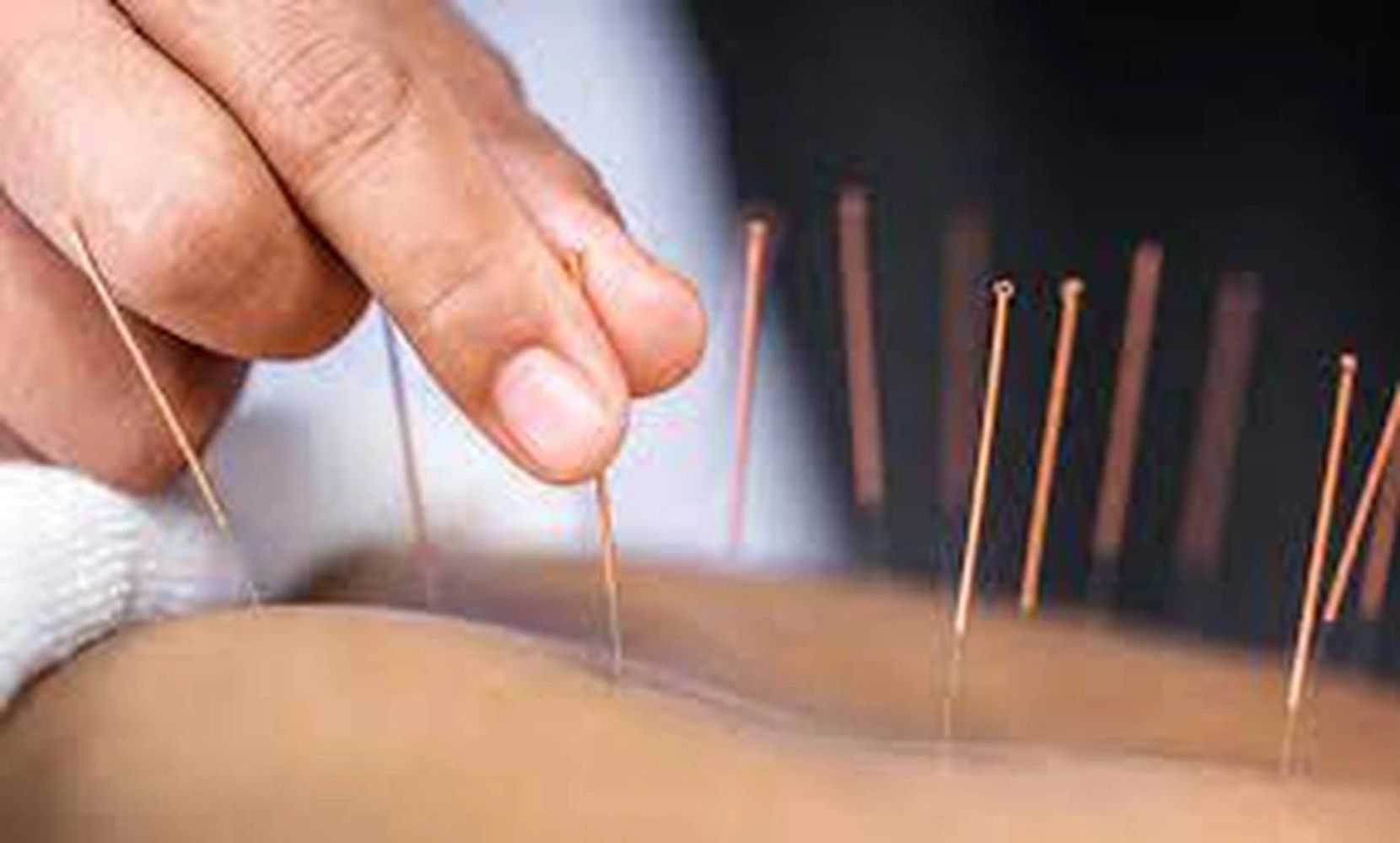 Acupuncture