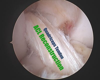 ACL reconstruction with quadriceps tendon autograft arthroscopic photo