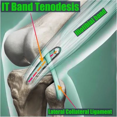 Iliotibial band tenodesis. ACL augmentation. LET.