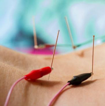 electric acupuncture, electricity, acupuncture