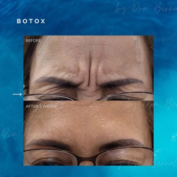 Botox Injection before and after results by Dr. Aicee Bernal, top Manila plastic surgeon
