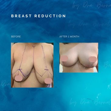 breast reduction surgery before and after by Dr. Aicee Bernal top plastic surgeon in Manila