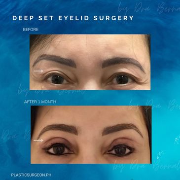Deep Set Eyelid surgery before and after results by Dr. Aicee Bernal, top plastic surgeon in Manila