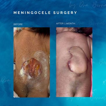 Spina bifida surgery also known as myelomeningocele surgery before and after by Dr. Aicee Bernal