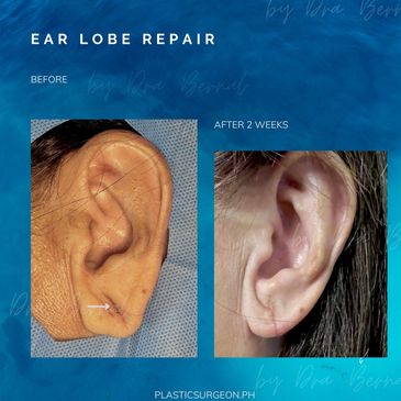 Before picture showing ear with large earring hole and sagging ear lobe.