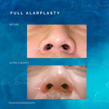 alarplasty before and after by Dr. Aicee Bernal