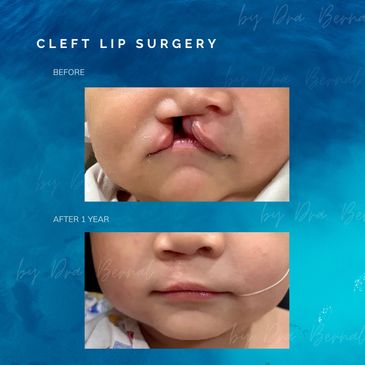 cleft lip and palate surgery before and after result by Dr. Aicee Bernal the best plastic surgeon