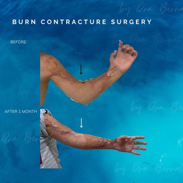 Burn scar surgery before and after results by Dr. Aicee Bernal, top plastic surgeon in Philippines