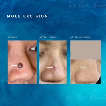 mole excision surgery before and after by Dr. Aicee Bernal top plastic surgeon in Manila