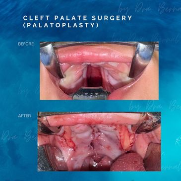 Cleft palate surgery or Palatoplasty before and after results by Dr. Aicee Bernal, plastic surgeon