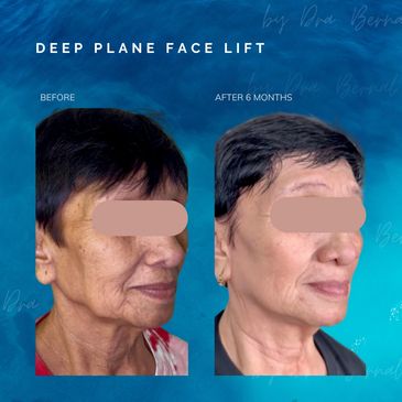 Deep plane facelift before and after with Dr. Aicee Bernal, facelift specialist in Manila