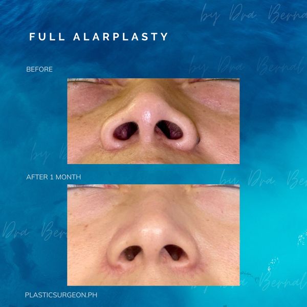 Natural alarplasty before and after picture done by best plastic surgeon for alarplasty Dr. Bernal