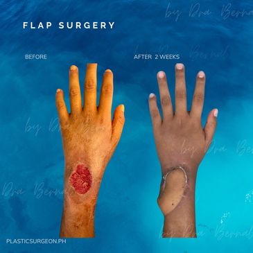 Flap Surgery before and after results by Dr. Aicee Bernal, top plastic surgeon in the Philippines