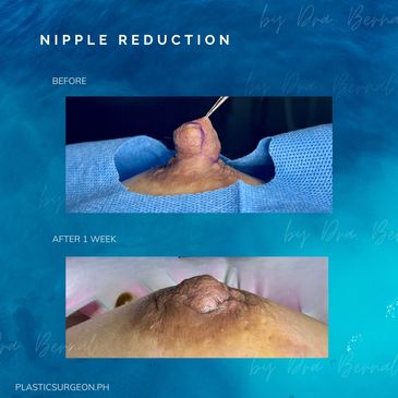 nipple reduction surgery before and after by Dr. Aicee Bernal top plastic surgeon in Manila