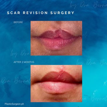Scar Surgery before and after results by Dr. Aicee Bernal, top plastic surgeon in the Philippines