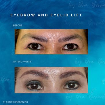 Eyebrow Lift before and after results by Dr. Aicee Bernal, top plastic surgeon in the Philippines