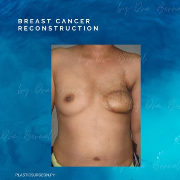 Breast reconstruction after breast cancer surgery or mastectomy before and after by Dr. Aicee Bernal
