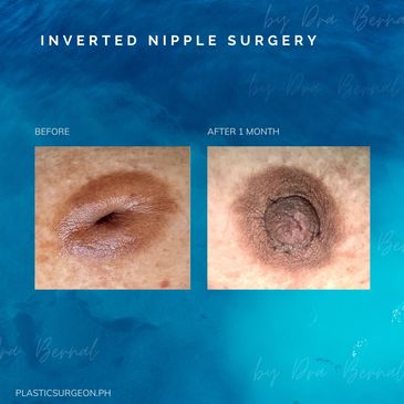 inverted nipple surgery before and after by Dr. Aicee Bernal top plastic surgeon in Manila