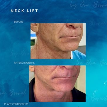 Neck Lift before and after results by Dr. Aicee Bernal, top plastic surgeon in the Philippines