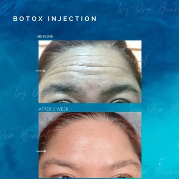 Botox before and after results by Dr. Aicee Bernal, top plastic surgeon in Manila