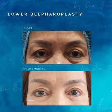 Lower Blepharoplasty before and after results by Dr. Aicee Bernal, top plastic surgeon in Manila