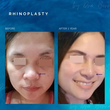 Rhinoplasty before and after results by Dr. Aicee Bernal, top plastic surgeon in the Philippines