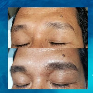 Male Eyebrow Microblading before and after results by Dr. Aicee Bernal, top plastic surgeon