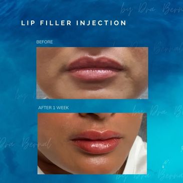 Lip Filler before and after results by Dr. Aicee Bernal, top plastic surgeon in the Philippines