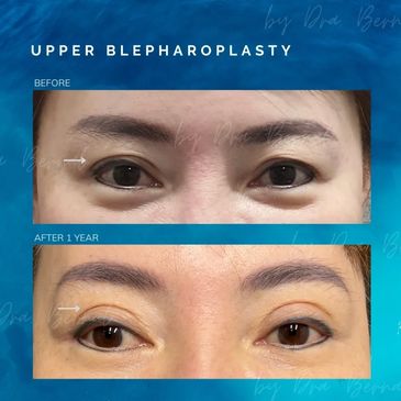 Upper Blepharoplasty before and after results by Dr. Aicee Bernal, top plastic surgeon in Philippine