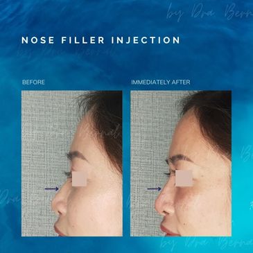 Nose Filler before and after results by Dr. Aicee Bernal, top plastic surgeon in the Philippines