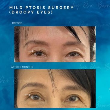Eyelid Ptosis surgery before and after results by Dr. Aicee Bernal, top plastic surgeon in Manila