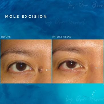 Mole Surgery before and after results by Dr. Aicee Bernal, top plastic surgeon in the Philippines
