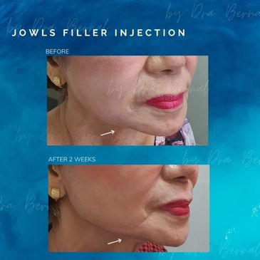 Jaw Filler before and after results by Dr. Aicee Bernal, top plastic surgeon in the Philippines