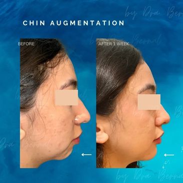 Chin Augmentation before and after results by Dr. Aicee Bernal, top plastic surgeon in Philippines