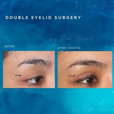 Double Eyelid Surgery before and after results by Dr. Aicee Bernal, top plastic surgeon in Manila