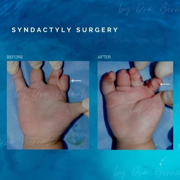 Syndactyly surgery before and after results by Dr. Aicee Bernal, top plastic surgeon in Philippines