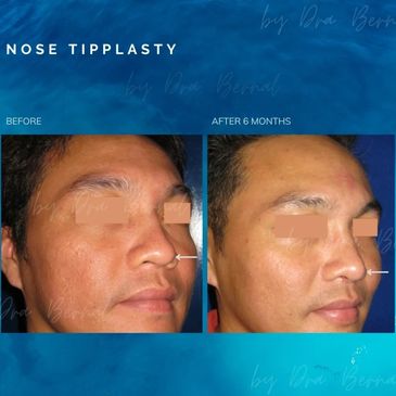 Nose Tipplasty before and after results by Dr. Aicee Bernal, top plastic surgeon in the Philippines