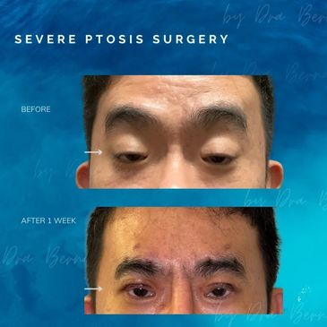Eyelid Ptosis before and after results by Dr. Aicee Bernal, top plastic surgeon in the Philippines
