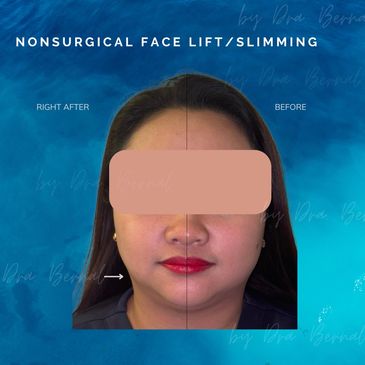 Non-surgical facelift before and after results by Dr. Aicee Bernal, top plastic surgeon in Manila
