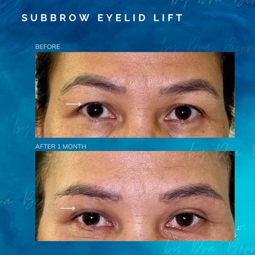 Subbrow Eyelid Lift before and after results by Dr. Aicee Bernal, top plastic surgeon in Philippines