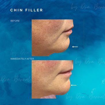 Chin Filler before and after results by Dr. Aicee Bernal, top plastic surgeon in the Philippines