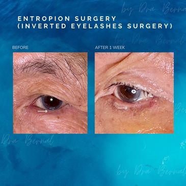entropion or inverted eyelashes plastic surgery before and after result by Dr. Aicee Bernal