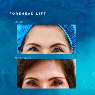 Forehead lift before and after result by Dr. Aicee Bernal,the top plastic surgeon in the Philippines