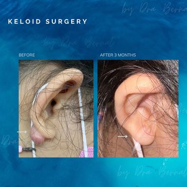 Ear Keloid before and after results by Dr. Aicee Bernal, top plastic surgeon in the Philippines