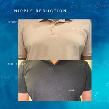 Nipple Reduction cosmetic Surgery before and after