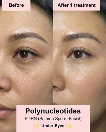 pdrn skin treatment for under eyes